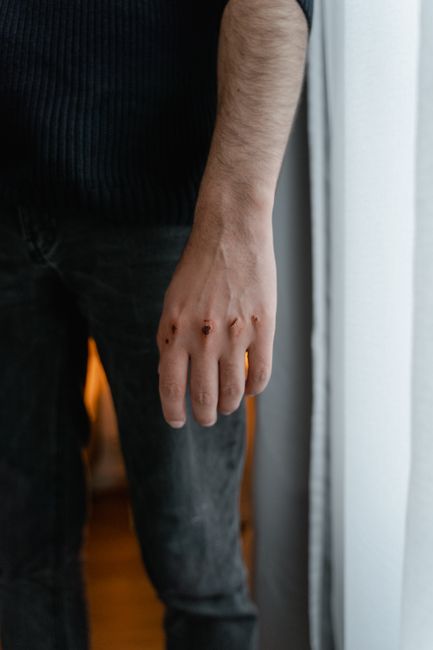 Close-up of a man's hand with visible wounds near a window indoors.